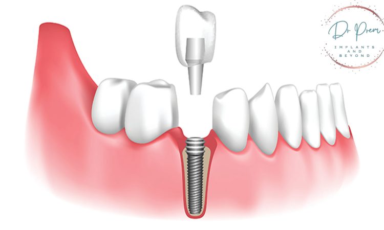 cost of all on 6 dental implants