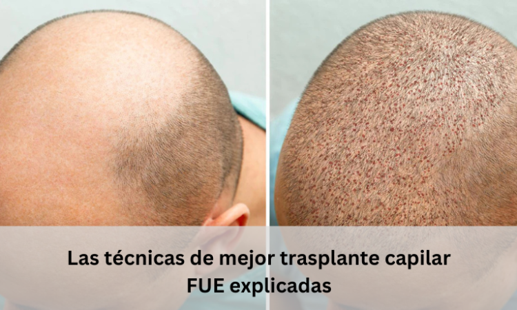 mejor trasplante capilar fue